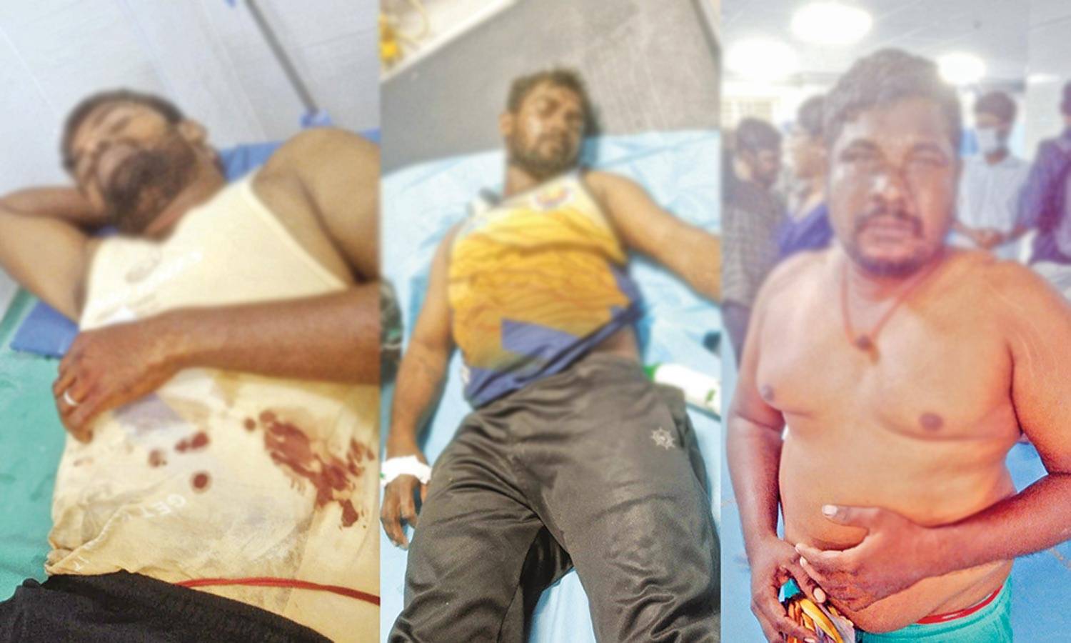 இலங்கை கடற்கொள்ளையர்களின் தாக்குதலுக்கு  இலக்கான இந்திய மீனவர்கள் வைத்தியசாலையில்