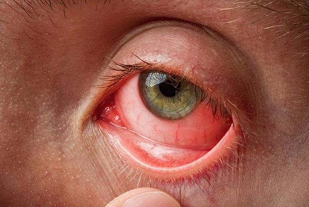 இளஞ்சிவப்பு கண் நோய் பரவும் அபாயம் இளஞ்சிவப்பு கண் நோய் பரவும் அபாயம்