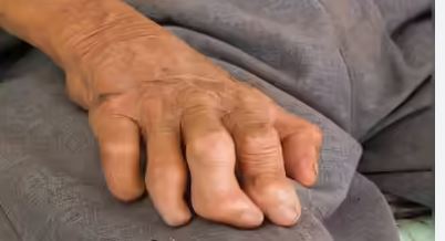 இலங்கையில் தொழுநோயாளிகளின் எண்ணிக்கையில் அதிகரிப்பு