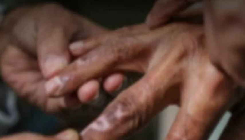 2025 இல் ஆயிரத்திற்கும் மேற்பட்ட தொழுநோயாளர்கள் பதிவு