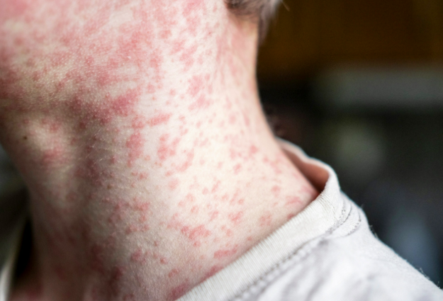 வடக்கு லண்டனில் வேகமாக பரவும் தட்டம்மை நோய்